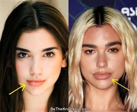 dua lipa lip injections.